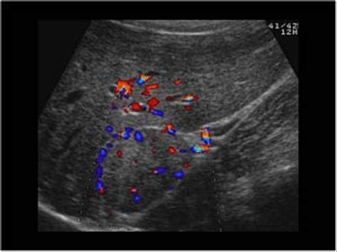 Abdomen and retroperitoneum | 1.10 Adrenal glands : Case 1.10.3 ...