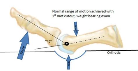 5th mtp joint pain - suplasopa