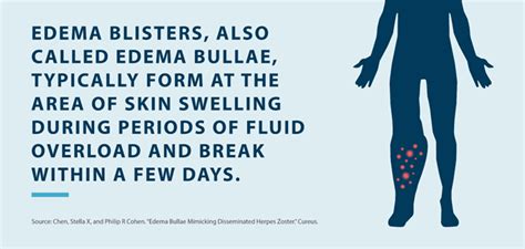 How to Treat Edema Blisters - Tactile Medical (2023)