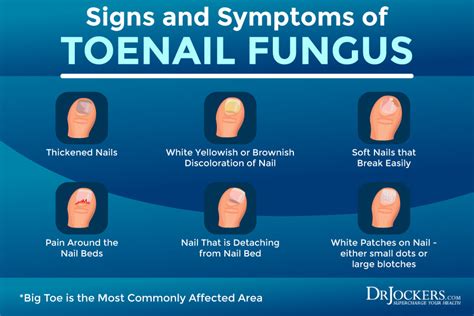 Toenail Fungus: Symptoms, Causes and Support Strategies