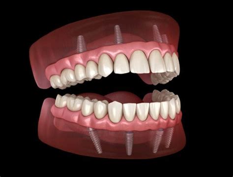 All-on-Four Implants for Edentulous Patients - Advanced Dental Implant ...