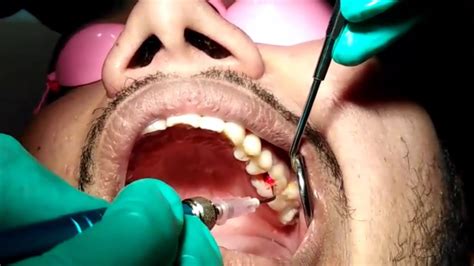 LASER Root Canal Treatment|| RAGHAV'S DENTAL CLINIC,Langar house,Hyderabad - YouTube