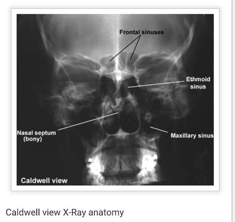 Caldwell view | Anatomy, Facial bones, X ray