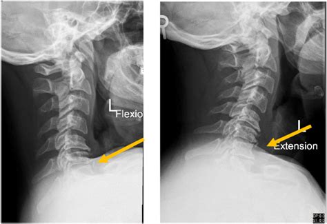 X-ray cervical spine dynamic lateral view showing stable cervical ...