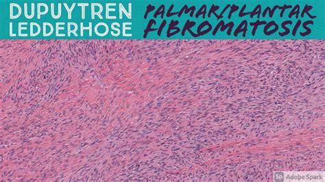 Palmar Fibromatosis (Dupuytren Contracture) & Plantar Fibromatosis: 5 ...