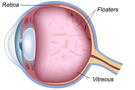 Eye Floaters Cause | Symptoms and Treatments - The Kitchensurvival