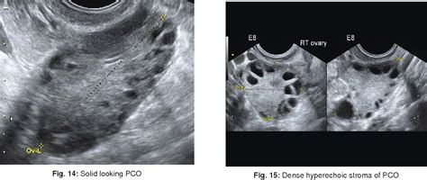 Figure 1 from Baseline Scan and Ultrasound Diagnosis of PCOS | Semantic ...