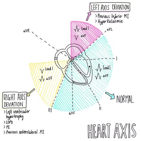 Axis Deviation Cardiac Sonography, Ekg Interpretation, Np School, Paramedic School, Mcat Study ...