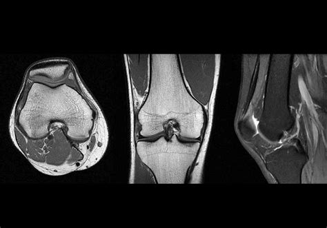 Mri Knee Coronal