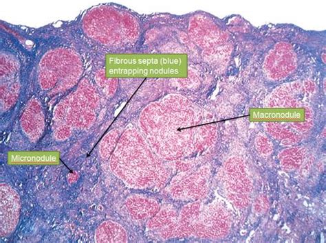 Morphology of Alcoholic Liver Disease | Medchrome