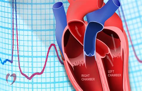 Heart Blocks: Types, Causes and Symptoms. | Gethealthlylife.com