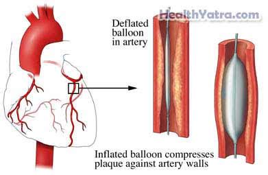 Best Cost Coronary Angioplasty (Balloon angioplasty) Surgery, Treatment Hospital in India