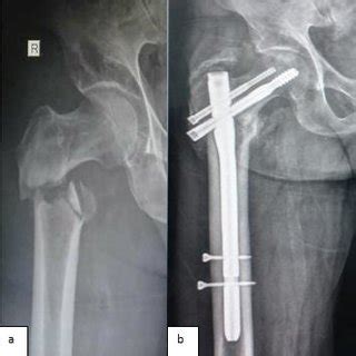 (PDF) Evaluation of the use of Proximal Femoral Nail (PFN) as a ...