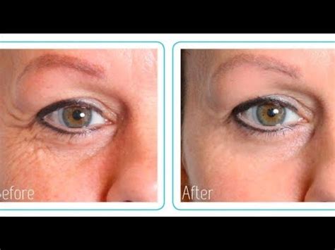 Hyaluronic Acid Before And After (MY RESULTS!) - YouTube