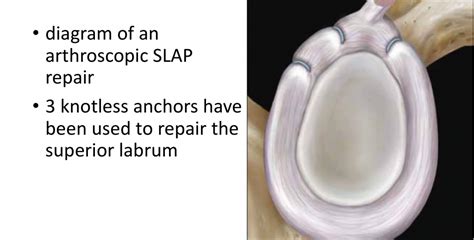 Fig 18. Arthro SLAP repair - Cambridge Shoulder