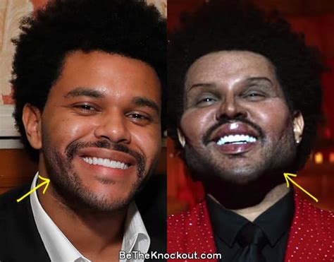 The Weeknd Plastic Surgery Comparison Photos