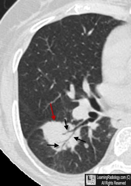 Learning Radiology - Masses with Air Bronchograms