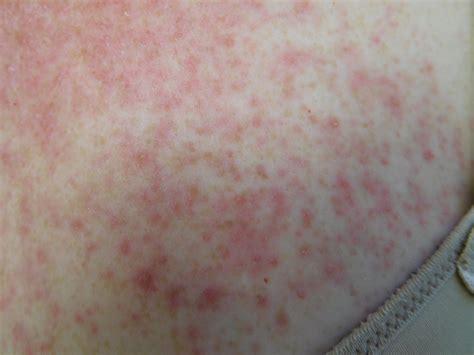 Cureus | Afatinib-Associated Cutaneous Toxicity: A Correlation of Severe Skin Reaction with ...