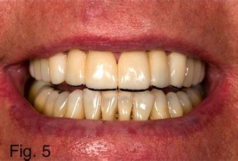 Positioning Maxillary Central Incisal Edges: Finalizing Incisal Edge Position - Spear Education