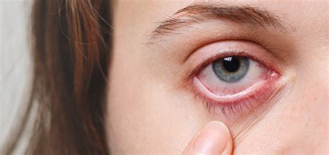 Red Eyes? Know about Conjunctivitis Infection Here! – Babiecorn – Buy ...