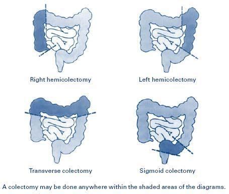 What Is A Medical Hemicolectomy