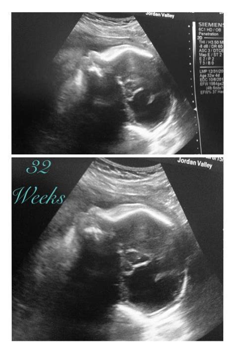 Noah's Journey: 8 Month Ultrasound Update