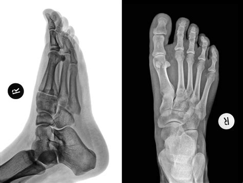 Displaced Trimalleolar Ankle Fracture