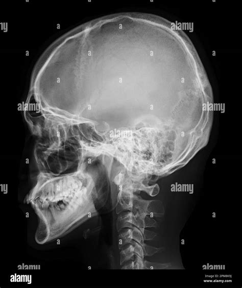 x-ray image of Human Skull lateral view for diagnosis skull fracture isolated on Black ...