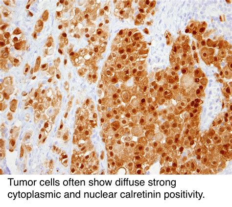 Stage 4 Papillary Thyroid Cancer