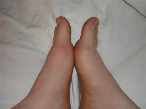 Gout Diet Plan | Styles At Life