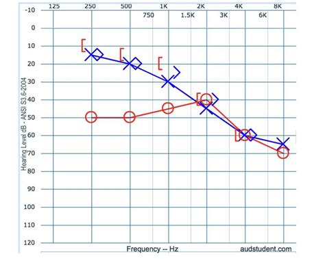 Is this a mixed hearing loss? I’m studying for a quiz : r/audiology