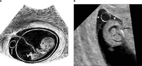 Sonographic Evaluation of the Yolk Sac - Tan - 2012 - Journal of Ultrasound in Medicine - Wiley ...