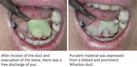 Obstructive Wharton Duct Sialadenitis - Journal of Emergency Medicine