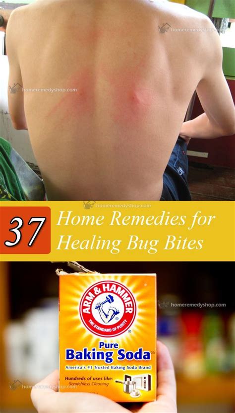 Baking soda for bug bites Home Health Remedies, Natural Home Remedies, Natural Healing, Bug ...