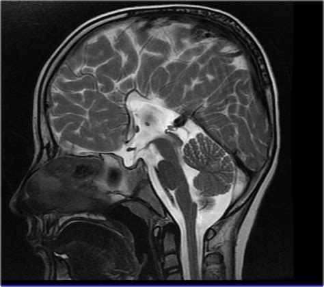 Mri Of The Brain Sagittal Slice En Medical Mri Brain Anatomy Mri | Images and Photos finder