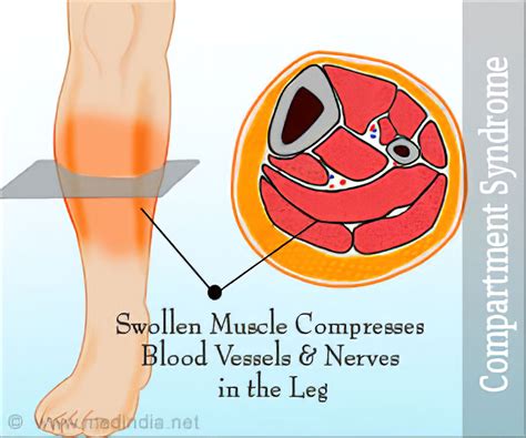 Compartment Syndrome - Motus Physical Therapy