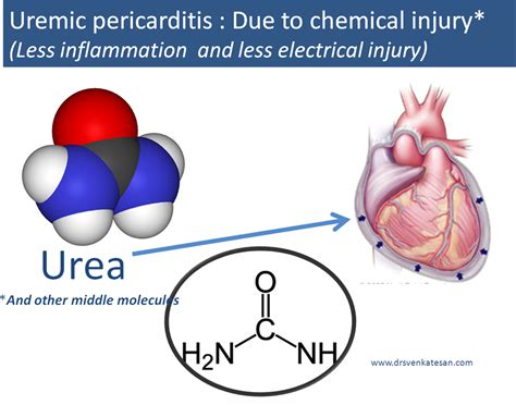 ecg changes in uremic pericarditis | Dr.S.Venkatesan MD | Metabolic disorders, Peritoneal ...