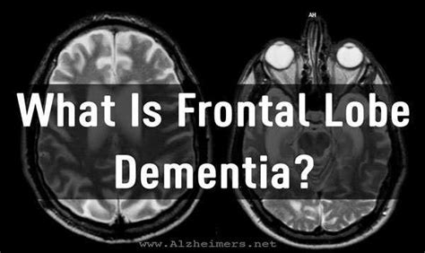 What Is Frontal Lobe Dementia? Frontal Lobe Dementia Stages by BOYER E