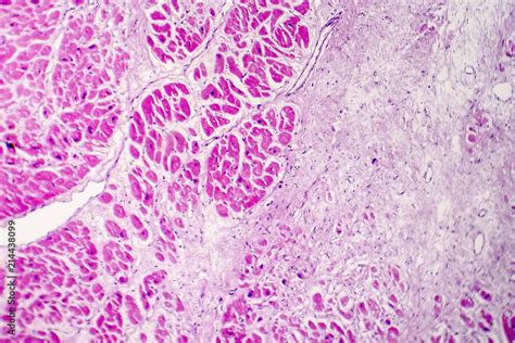 Acute myocardial infarction, histology of heart tissue, light micrograph. Area of infarct is ...