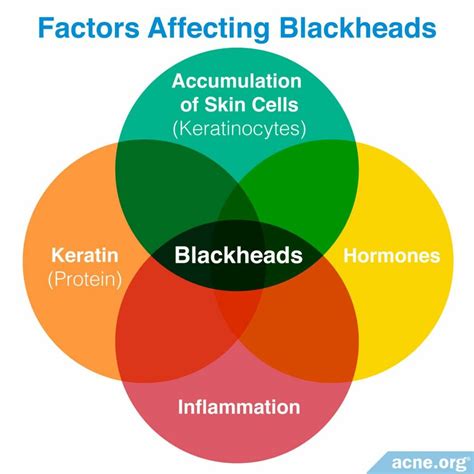 What Is a Blackhead? - Acne.org