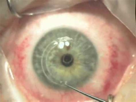 Intacs for keratoconus surgical procedure - YouTube