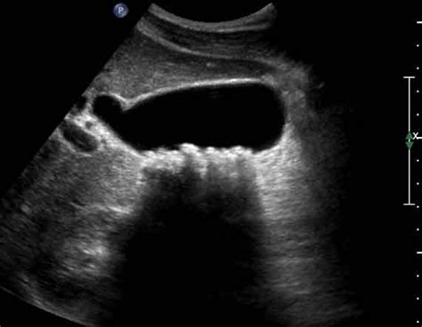 Gallbladder Ultrasound Jeopardy Template