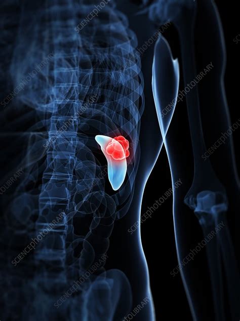 Spleen cancer, artwork - Stock Image - F006/2505 - Science Photo Library