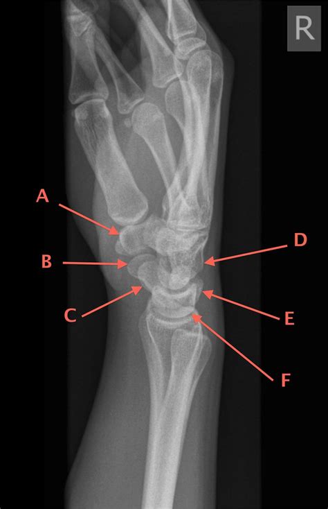 Lateral Wrist X Ray Anatomy | Porn Sex Picture