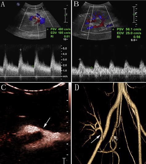 Renal Artery Stenosis Radiology