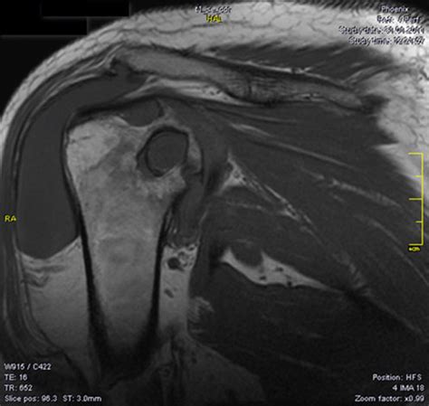 Magnetic resonance imaging (MRI) of the shoulder demonstrates synovial ...