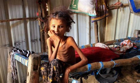 United Nations statistics reveal harrowing numbers of malnourished and starving children in ...