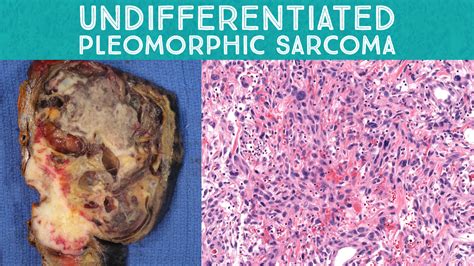 Spindle Cell Neoplasm Pathology 101: Undifferentiated pleomorphic ...