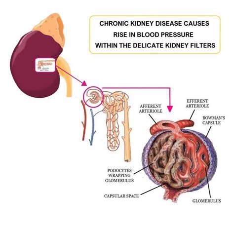 High Blood Pressure in CKD | All Things Kidney ~ Official