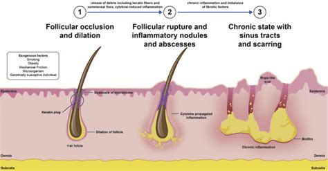 Hidradenitis Suppuritiva — CREOGS Over Coffee